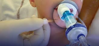 Image result for Ear Nerve Block