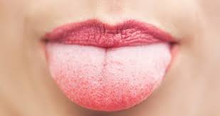 18 Proven Home Remedies For White Furry Tongue