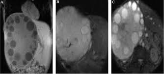 The radiologic findings range from purely … Imaging In Echinococcosis Intechopen