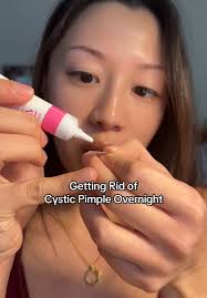 Cystic Pimple Cheat Code: Effective Overnight Solution