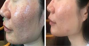 Before And After Treatment