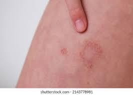 Image result for dermatitis contacta allergica