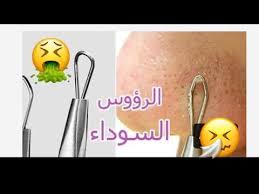 طريقه استخدام إبره تنضيف البشرة وازالة الرؤوس السوداء والبثور وحب الشباب youtube