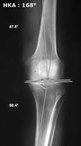 Image result for Genu Varum