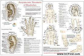 Acupuncture Treatment Of Headaches Chart