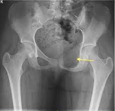 Fsa tumors are found commonly around the skull, pelvis, spine and ribs. Cureus Pelvic Aneurysmal Bone Cyst In An Adolescent A Case Report And Literature Review