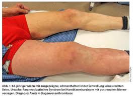 Tiefe Beinvenenthrombose Konservative Therapie Doctors Today