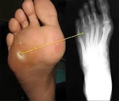 Image result for Probe-to-Bone Test