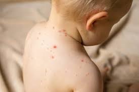Pada video kali ini asaljeplak akan memberikan sedikit informasi mengenai penyakit rubella alias campak jerman atau campak 3 hari.di dalam video ini akan. Demam Campak Boleh Membawa Maut Daily Rakyat
