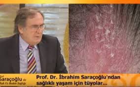 Sac Derisinde Kabuklanma Ibrahim Saracoglu