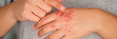 Image result for Hand Dermatitis