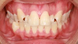 If you need to correct crowded or crooked teeth, traditional braces are one of the most tried and. Guide To Spacers Parris Orthodontics