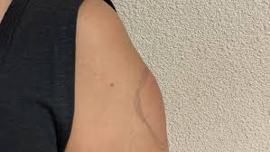 This is the story of one of those doses — and how it ended up in thomas' left arm. Moderna Vaccine Causing Covid Arm Among Some Patients Kmph