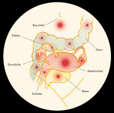 Learn more about the types, symptoms, causes, diagnosis, stages, treatment, and. Einfache Sprache Was Ist Endometriose Endometriose Vereinigung Deutschland E V