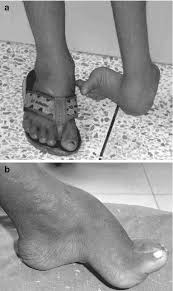 Image result for Clubfoot