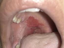 Image result for Erythroplakia roof of mouth