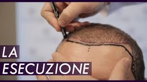 Facciamo chiarezza circa prezzi e costi da sostenere per le diverse tipologie di autotrapianto capelli: Trapianto Capelli Turchia Ecco Il Risultato Finale Youtube