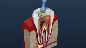 The crown provides your tooth with the necessary support. How Long Does A Root Canal Take In 2020 Smile Angels Of Beverly Hills