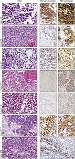 Carcinoma is a type of cancer that develops in the skin or tissues covering or lining internal organs. Tumor Of The Touch Cells A First Of Its Kind Study In India Eurekalert Science News