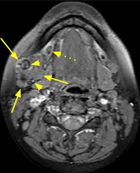 Image result for Sialolithiasis