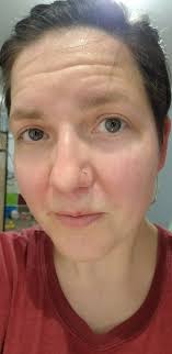 Has anyone used Mederma scar gel and what were the results?