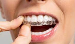 An overbite is a dental condition impacting the aesthetics of your mouth, your smile and your jaw mechanics. Can You Fix An Overbite With Invisalign Fine Orthodontics Blogfine Orthodontics Blog