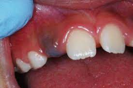 Permanent Tooth Eruption In Children Frisco Kid S Dentistry