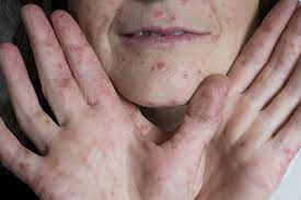 Hand Fuss Mund Krankheit Definition Symptome Therapie