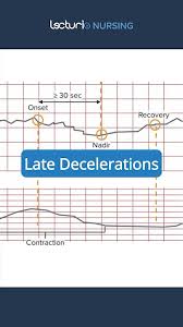 Image result for Late Deceleration