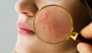 Image result for red rash face