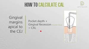 Dentiscope How To Determine Clinical Attachment Loss