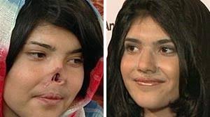 &amp;quot;Bibi&amp;quot; Ayesha: (L) Afghanistan woman whose nose was cut off. &quot;Bibi&quot; Ayesha: (L) Afghanistan woman whose nose was cut off by her Taliban husband ... - abc_bibi_aisha_101011_wmain