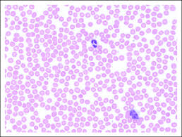 Image result for Peripheral Smear