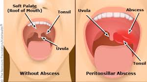 Image result for Strep throat infection roof of mouth