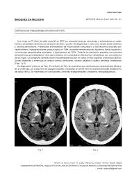 Through the use of ct scans, calcifications are seen primarily in the basal ganglia and in other areas such a. Pdf Calcificaciones Intracerebrales Sindrome De Fahr