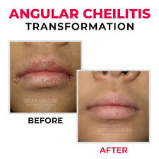 Image result for Angular Stomatitis