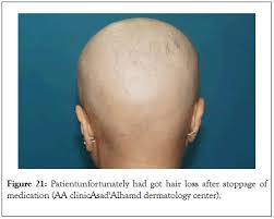 Female pattern hair loss (fphl) is a distinctive form of hair loss that occurs in women with androgenetic alopecia. Alopecia Areata In Kuwaiti Patients With Dermoscopy View Of Some Cases