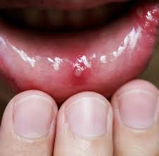 Alergiile, ezceme, acnee, psoriazis, dermatita simpla sau seboreica, ten foarte gras sau foarte uscat. Ulcerele Aftoase Simptome Tratament