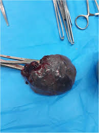 As blood enters the abdominal cavity, it can lead to a symptom known as referred pain. The Presentation Of Spontaneous Splenic Rupture In A Covid 19 Patient A Case Report Bmc Surgery Full Text