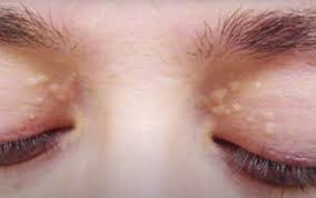 Image result for xanthelasma of eyelid