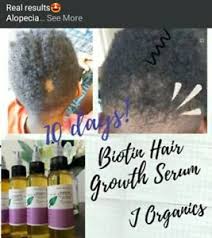 Nourished with biotin and bamboo, it gently cleanses the hair without stripping essential oils. Hair Growth Serum With Biotin For Balding Thinning Hair Bald Spot Regrowth Ebay