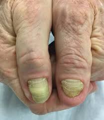 Image result for Yellow nail syndrome feet