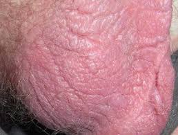 Liquen Simple Del Escroto Hoogstra Centros Medicos