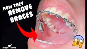Don't try this at home. Will A Dentist Remove Braces