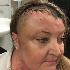 Brain tumour mum turned away by doctors TEN times and told it was just the  menopause