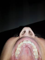 Image result for Erythroplakia roof of mouth