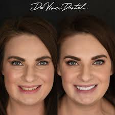 Do you want to get gorgeous straight white teeth with Veneers? Is the idea  of drilling down your teeth what's holding you back? We have solved this  problem by mastering Veneers that