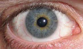 Eye Makeup For Grey Eyes From Multicolored To Deep Steel Central Heterochromia Heterochromia Heterochromia Iridum