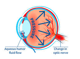 Image result for Glaucoma