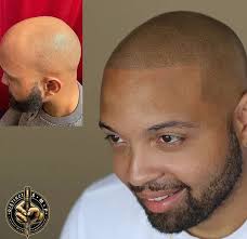 The Non-Invasive and Cost-Effective Hair Loss Solution